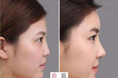 隆鼻手術(shù)3天拆了會(huì)歪嗎？歪了怎么辦？