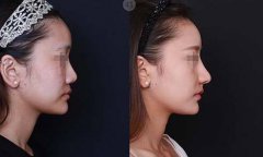 膨體隆鼻是*的嗎？多久恢復(fù)？