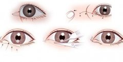 開眼角失敗怎么辦？有疤怎么辦？
