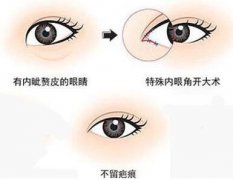 韓式*開眼角價(jià)格