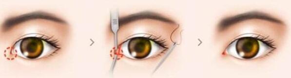 開(kāi)眼角好看嗎