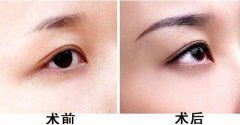 種植眉毛的適合人群有哪些？眉毛種植果圖？