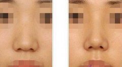 做了隆鼻手術(shù)后的護(hù)理，具體注意事項(xiàng)