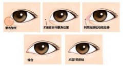 開眼角手術(shù)風(fēng)險(xiǎn)大嗎？如何規(guī)避？