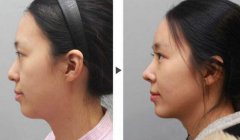 隆鼻術(shù)前注意，術(shù)前準(zhǔn)備有哪些