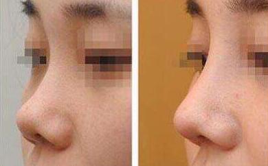 隆鼻術(shù)前注意，術(shù)前準備有哪些