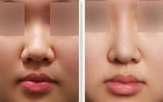 隆鼻固定膠帶幾天去掉?多久可以撕?