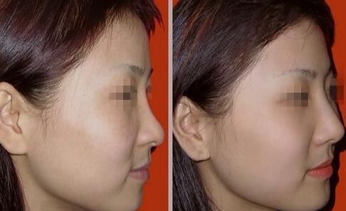 隆鼻以后怎么恢復(fù)快，術(shù)后如何護(hù)理?