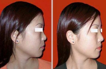 隆鼻以后怎么恢復(fù)快，術(shù)后如何護(hù)理?