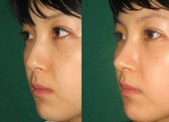 隆鼻手術(shù)恢復(fù)要多久，幾天恢復(fù)自然?