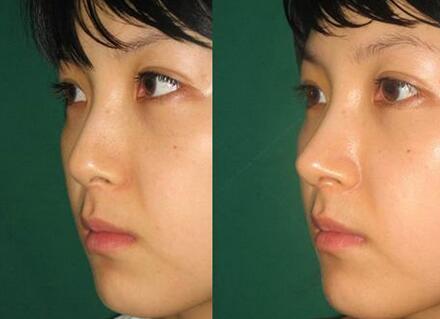 隆鼻手術(shù)恢復(fù)要多久，幾天恢復(fù)自然?