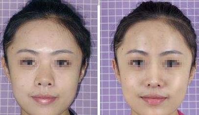 北京膨體隆鼻價格是多少？膨體隆鼻手術(shù)多少錢？