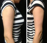 手臂吸脂術(shù)前準(zhǔn)備，術(shù)前注意事項(xiàng)有那些？