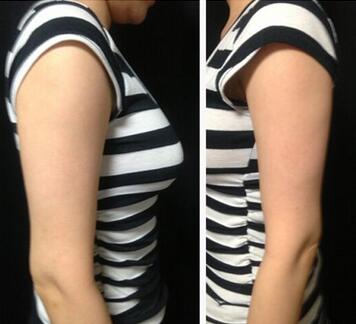 手臂吸脂術(shù)前準(zhǔn)備，術(shù)前注意事項有那些？