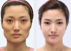 磨顴骨多少錢？磨顴骨危險(xiǎn)嗎？