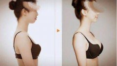 娜琦麗假體隆胸多少錢？娜琦麗假體多久變軟？