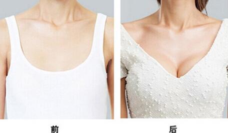 假體豐胸能保持多久，假體豐胸*果可以維持多久？