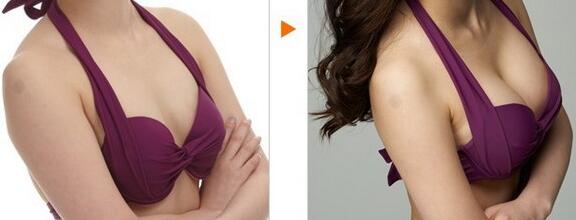 威寧假體豐胸怎么樣？威寧假體豐胸*果如何？