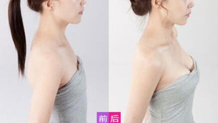 威寧假體豐胸怎么樣？威寧假體豐胸*果如何？