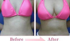 妙桃假體豐胸費(fèi)用？妙桃假體大概多少錢？