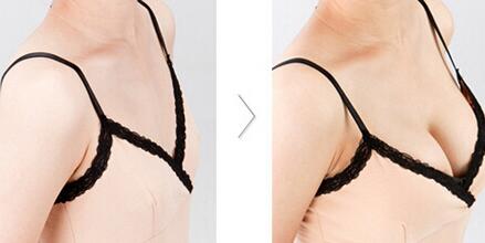 上海內(nèi)窺鏡假體豐胸怎么樣？*內(nèi)窺鏡假體豐胸介紹