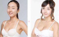 上海假體豐胸手術(shù)多少錢？上海假體豐胸價(jià)格？