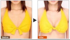 假體豐胸好的醫(yī)院有哪些？假體豐胸介紹？