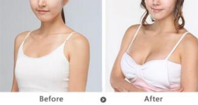 假體豐胸的副作用有哪些？假體豐胸*嗎？