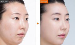 光子嫩膚果能維持多久、全身光子嫩膚多少錢？