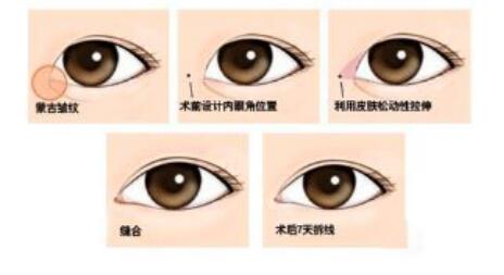 韓式開眼角手術(shù)*果怎么樣？開眼角前后照