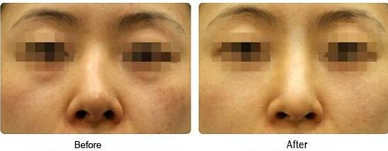 歪鼻矯正風險大嗎、歪鼻矯正手術(shù)多少錢