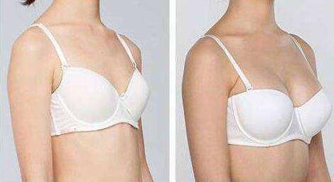 內(nèi)窺鏡隆胸到底痛不痛？?jī)?nèi)窺鏡隆胸多少錢？