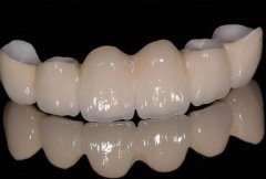 種植烤瓷牙的價(jià)格？種植烤瓷牙大概多少錢(qián)？