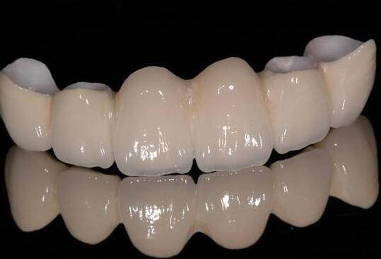 種植烤瓷牙,價格,多少錢