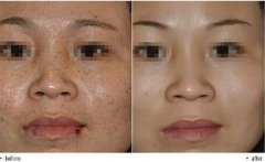 治雀斑多少錢(qián)？治雀斑價(jià)格是多少？