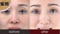 治雀斑的方法是什么？治雀斑的*方法？