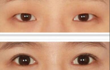 做開眼角價格、開眼角費用詳細解析