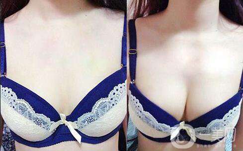 湛江做假體豐胸怎么樣？假體豐胸的*果好嗎？