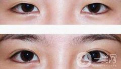割雙眼皮多少錢(qián)？雙眼皮手術(shù)費(fèi)用詳細(xì)解答