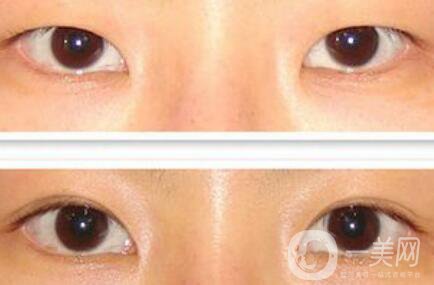 割雙眼皮多少錢？雙眼皮手術費用詳細解答