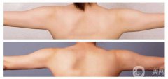 手臂吸脂術*嗎？手臂吸脂有危險嗎？