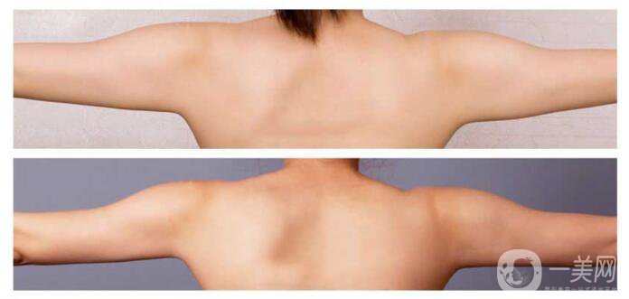 手臂吸脂術(shù)*嗎？手臂吸脂有危險嗎？