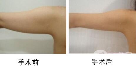 手臂吸脂術(shù)*嗎？手臂吸脂有危險嗎？