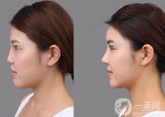 膨體隆鼻能維持多久？膨體隆鼻能保持終生嗎？