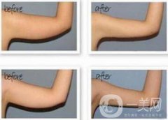 手臂吸脂風險有哪些？手臂吸脂有副作用嗎？