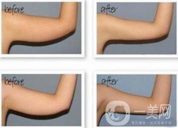 手臂吸脂風險有哪些？手臂吸脂有副作用嗎？