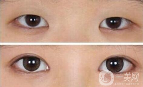 開眼角需要多少錢？開眼角和不開的區(qū)別圖