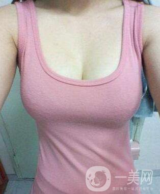 假體豐胸材料有哪些 假體隆胸品牌大解析