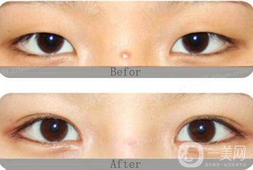 開(kāi)眼角割雙眼皮價(jià)格、開(kāi)眼角割雙眼皮多少錢？