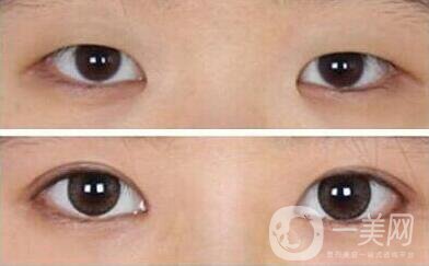 開(kāi)眼角割雙眼皮價(jià)格、開(kāi)眼角割雙眼皮多少錢？